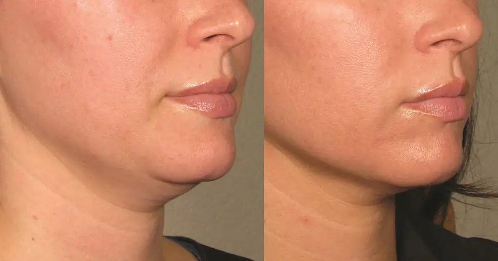 HIFU Treatment Before After