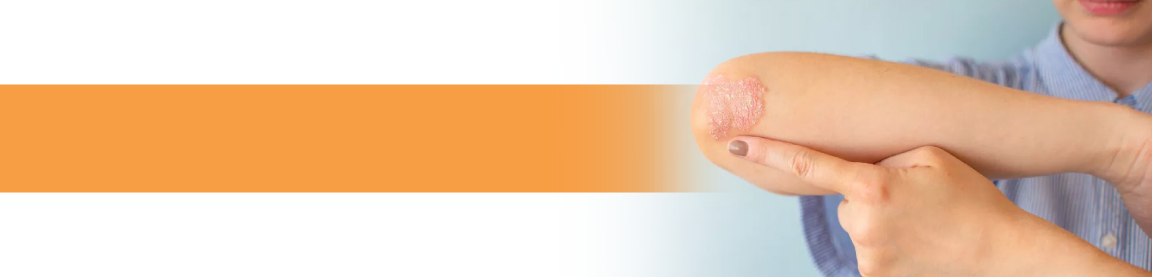 psoriasis_treatment