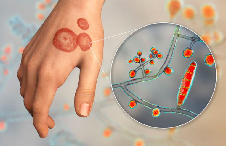 Fungal Disease Treatment