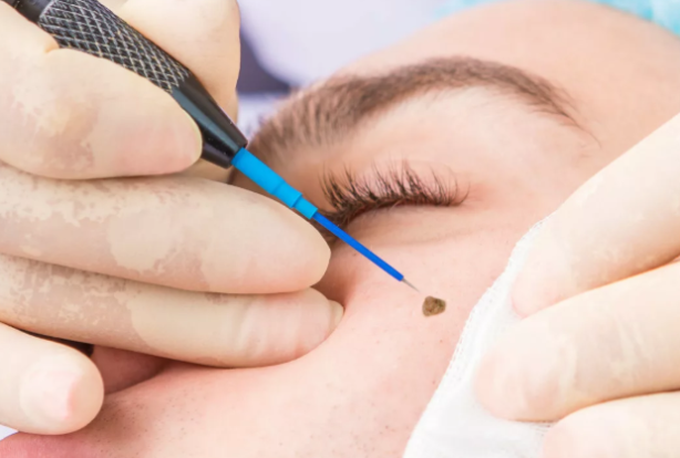 Fulguration Treatment