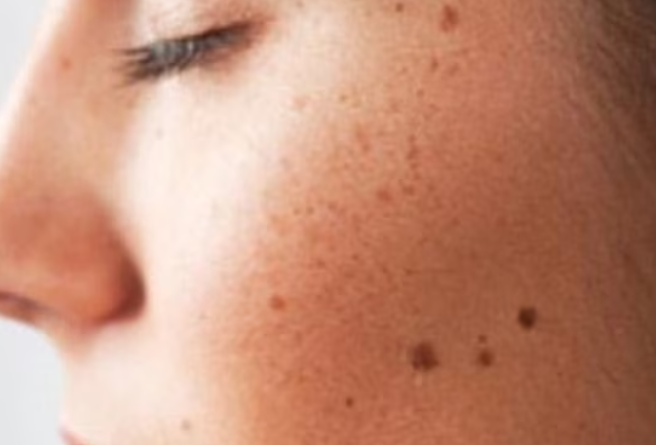 Fulguration Treatment