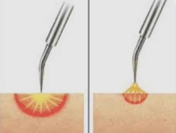 fulguration treatment