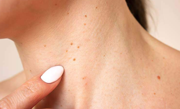 fulguration treatment in lahore