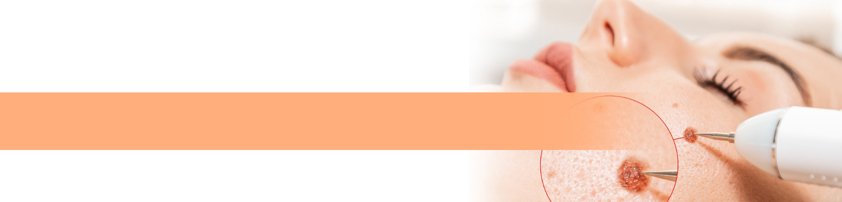 chemical_peels_treatment