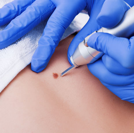 fulguration treatment.