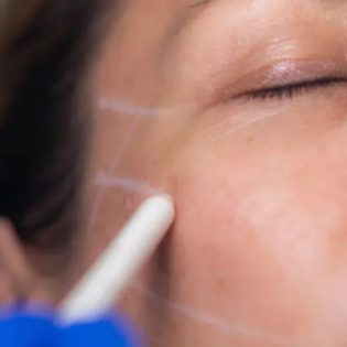 Thread Lift Treatment