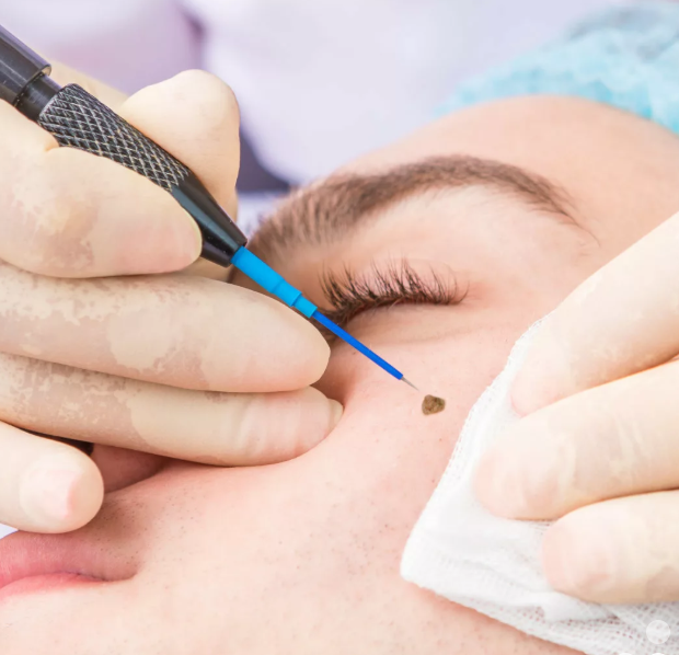 Professional wart removal in Lahore at DASC