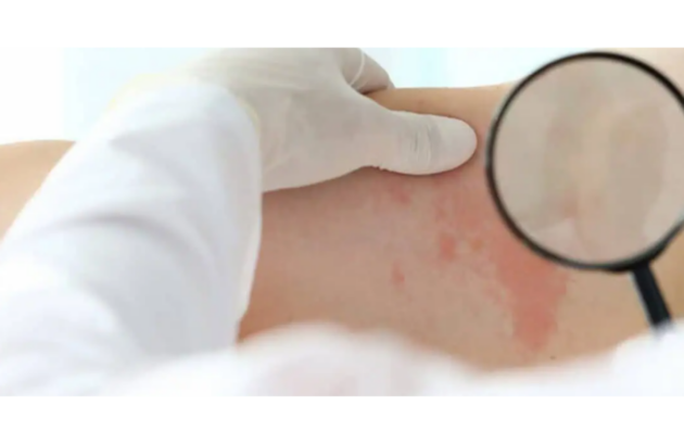Eczema Treatment Near me
