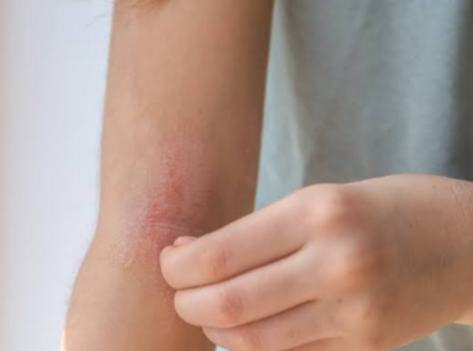 eczema treatment in Lahore