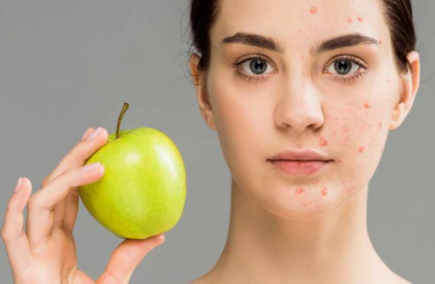 How Diet Affects Acne