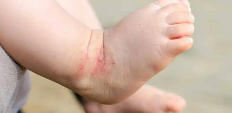 Kids Eczema Treatment