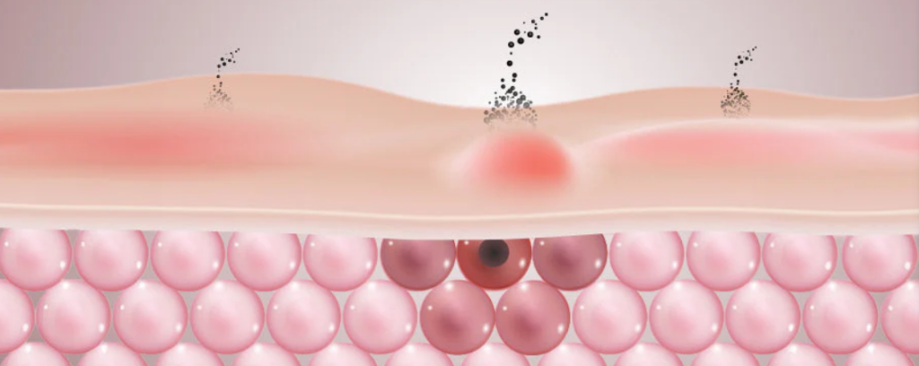 acne treatment in Lahore