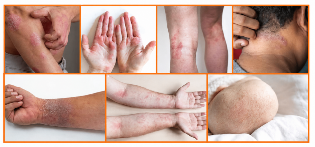 Eczema treatment near me