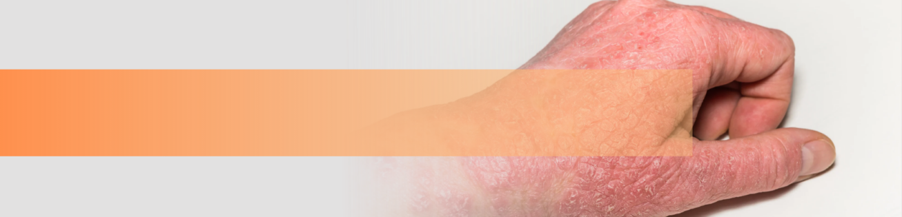 acne_treatment